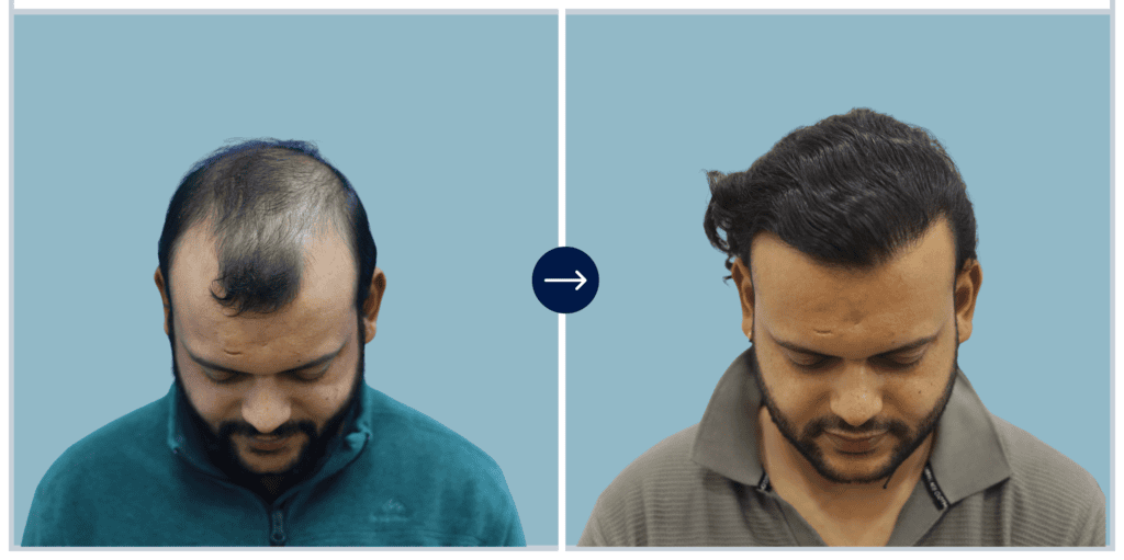 Alloroots Hair Transplant Clinic - India's Best Hair Transplant Services