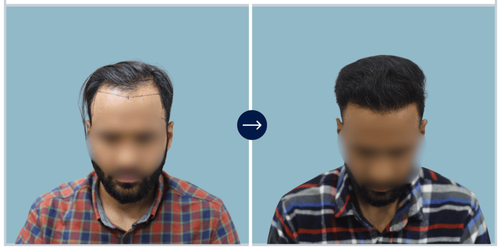 Results - Alloroots Hair Transplant Clinic - India's Best Hair Transplant Services