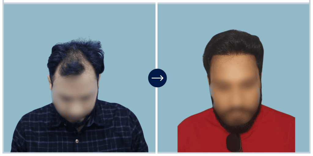Results - Alloroots Hair Transplant Clinic - India's Best Hair Transplant Services