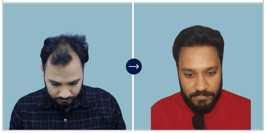 Alloroots Hair Transplant Clinic - India's Best Hair Transplant Services