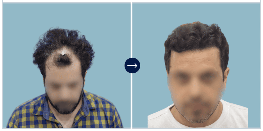 Results - Alloroots Hair Transplant Clinic - India's Best Hair Transplant Services