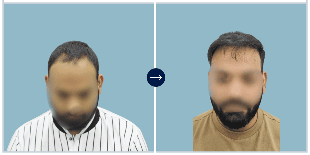 Results - Alloroots Hair Transplant Clinic - India's Best Hair Transplant Services