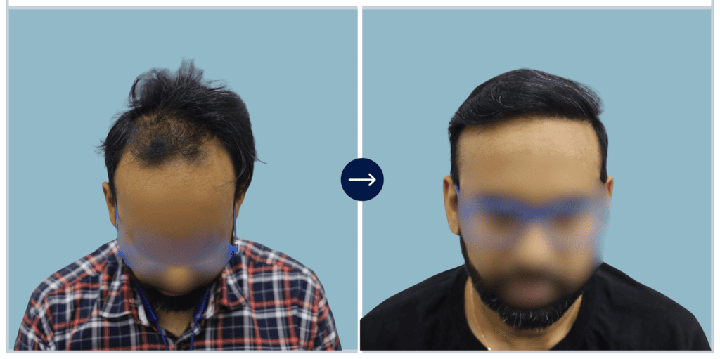 Results - Alloroots Hair Transplant Clinic - India's Best Hair Transplant Services