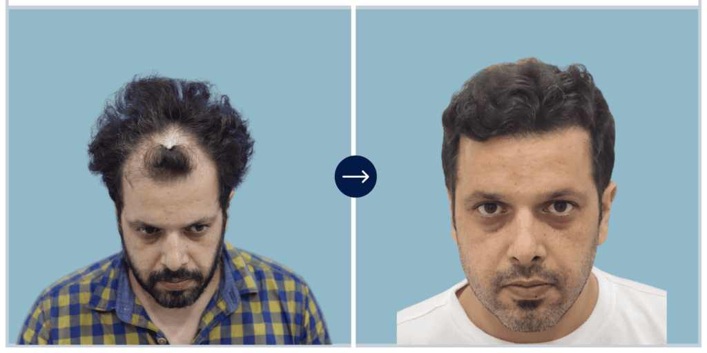 Alloroots Hair Transplant Clinic - India's Best Hair Transplant Services