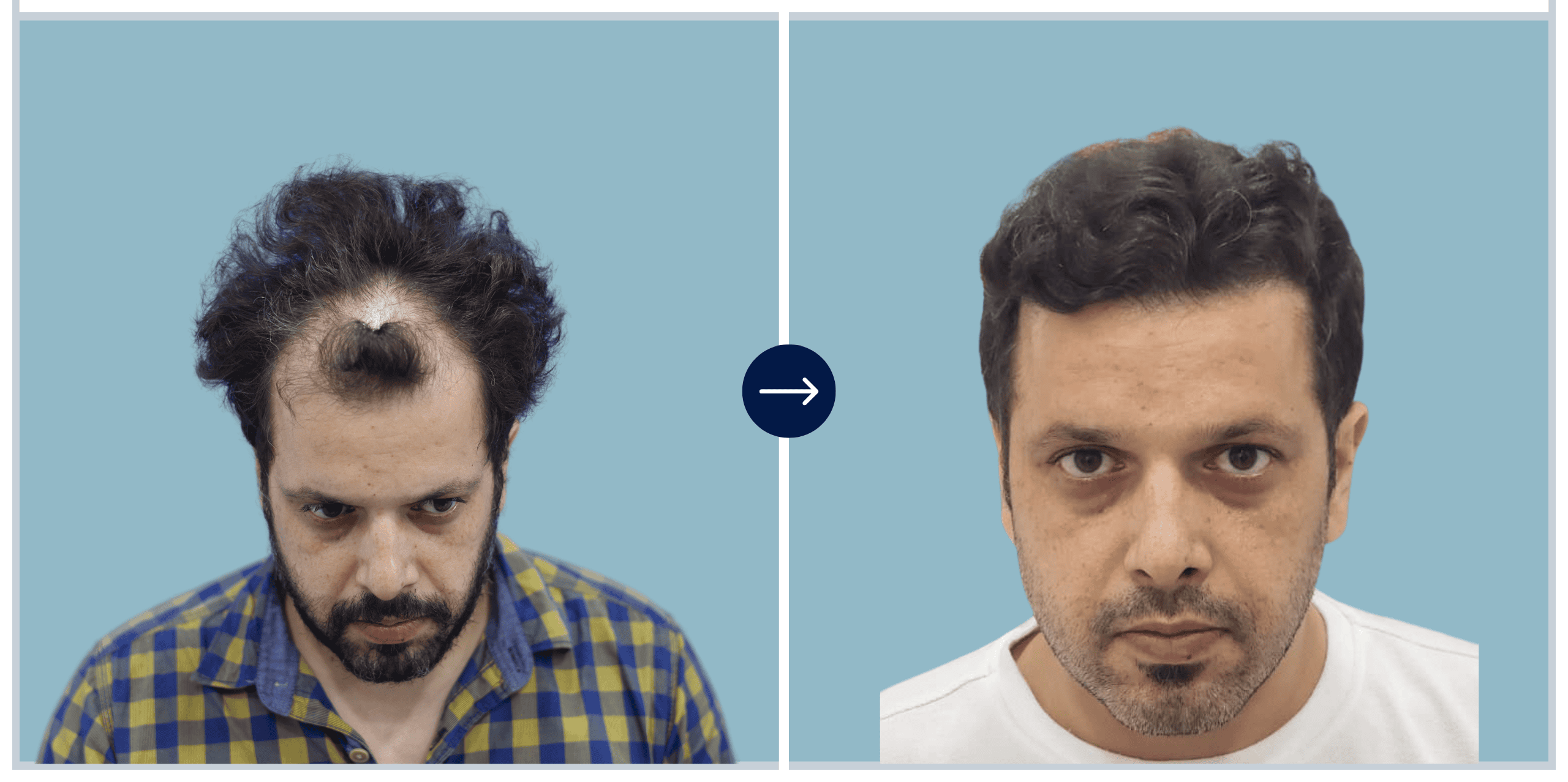 Alloroots Hair Transplant Clinic - India's Best Hair Transplant Services