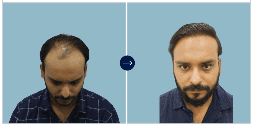 Alloroots Hair Transplant Clinic - India's Best Hair Transplant Services