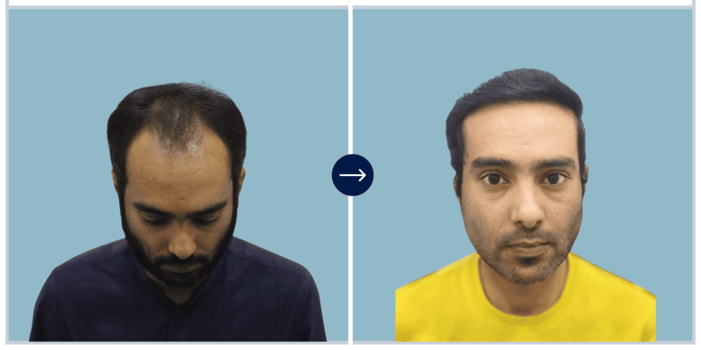Alloroots Hair Transplant Clinic - India's Best Hair Transplant Services