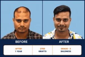 Your First Hair Transplant Visit in Patia, Bhubaneswar: What to Expect, Step by Step - Alloroots Hair Transplant Clinic - India's Best Hair Transplant Services