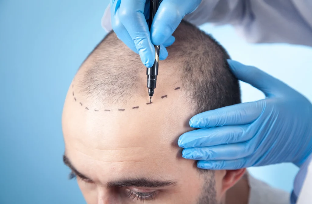 PRP Hair Treatment in Bhubaneswar: Cost, Sessions, Results & Who It Actually Helps (2026) - Alloroots Hair Transplant Clinic - India's Best Hair Transplant Services