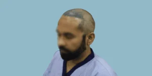 Hair Transplant Cost in Bhubaneswar (2026): Price Per Graft, Packages & EMI - Alloroots Hair Transplant Clinic - India's Best Hair Transplant Services