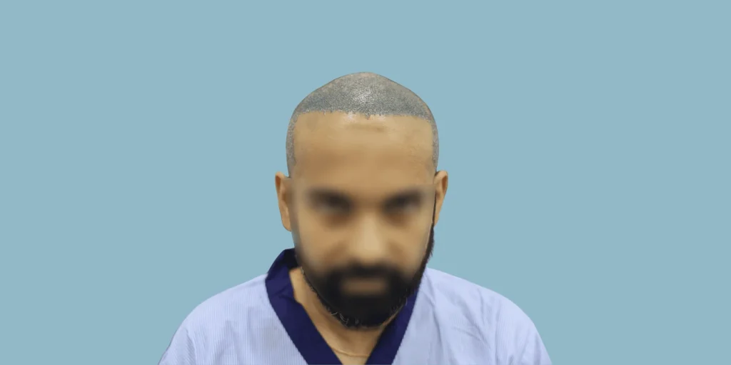 FUE Hair Transplant in Bhubaneswar: Procedure, Cost & Real Results (2026) - Alloroots Hair Transplant Clinic - India's Best Hair Transplant Services