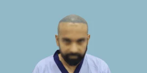 FUE Hair Transplant in Bhubaneswar: Procedure, Cost & Real Results (2026) - Alloroots Hair Transplant Clinic - India's Best Hair Transplant Services