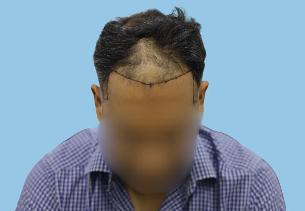 Hair Transplant Cost in India by Technique (2026) - Alloroots Hair Transplant Clinic - India's Best Hair Transplant Services