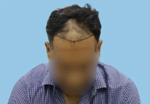 Hair Transplant Cost in India by Technique (2026) - Alloroots Hair Transplant Clinic - India's Best Hair Transplant Services