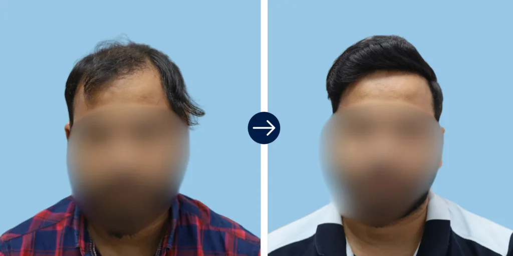 Hair Transplant Cost in Greater Kailash II (GK-2), Delhi - Alloroots Hair Transplant Clinic - India's Best Hair Transplant Services