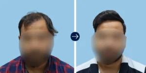 Hair Transplant Cost in Greater Kailash II (GK-2), Delhi - Alloroots Hair Transplant Clinic - India's Best Hair Transplant Services