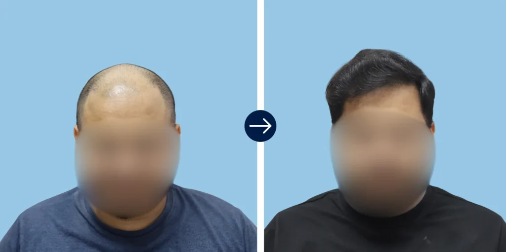 PRP & Non-Surgical Hair Loss Treatment in Greater Kailash III (GK-3), Delhi - Alloroots Hair Transplant Clinic - India's Best Hair Transplant Services