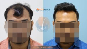 FUE Hair Transplant in Kailash Colony, Delhi - Alloroots Hair Transplant Clinic - India's Best Hair Transplant Services