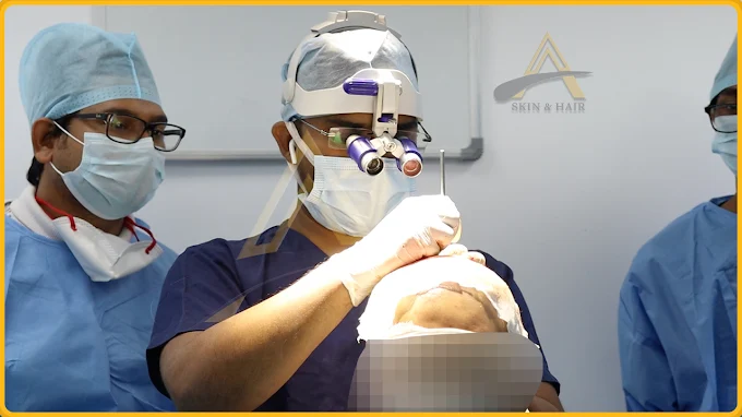 Custom Blog 1 7 NRI Hair Transplant in Delhi: World-Class Results, a Fraction of Western Cost - Alloroots Hair Transplant Clinic - India's Best Hair Transplant Services
